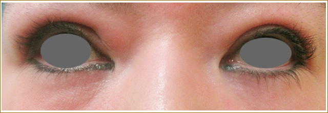 瞼のアートメイク除去治療前の写真