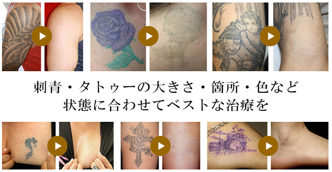 学術症例モニター募集