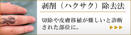剥削(ハクサク)法で刺青タトゥー除去