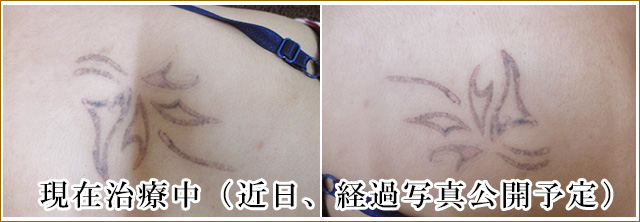 刺青タトゥー除去治療前の写真