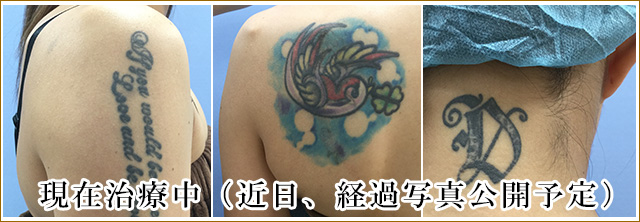 腕、肩、背中に入っている刺青タトゥー除去治療前の写真