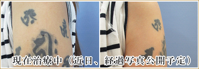 腕の刺青タトゥー除去治療前の写真
