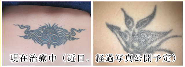 腰の刺青タトゥー除去治療前の写真