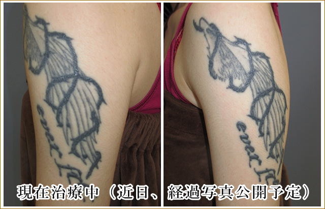 腕の刺青タトゥー除去治療前の写真