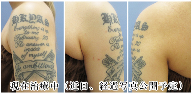 切除法による腕の刺青タトゥー除去治療前の写真
