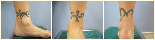 足首の刺青タトゥー除去治療前の写真
